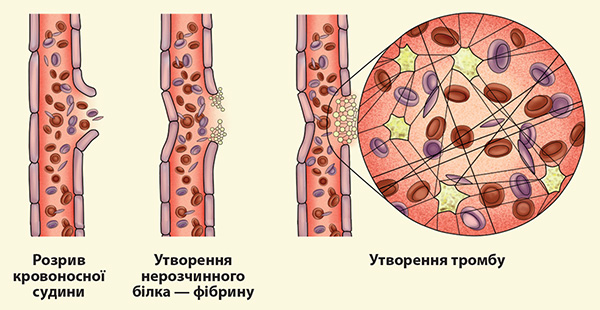 Утворення тромба